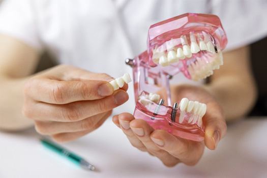 Dentist’s hands holding sample implant bridge