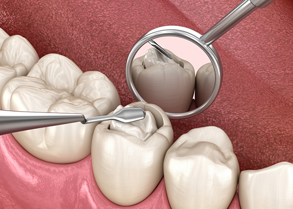 Illustration of dental instruments removing a portion of a tooth