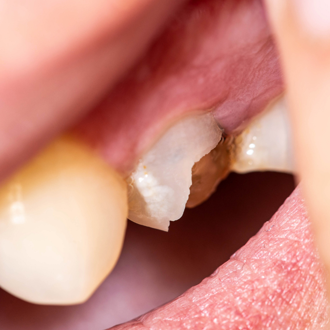 Chipped Tooth Brenham, 1 Best Expert Repair