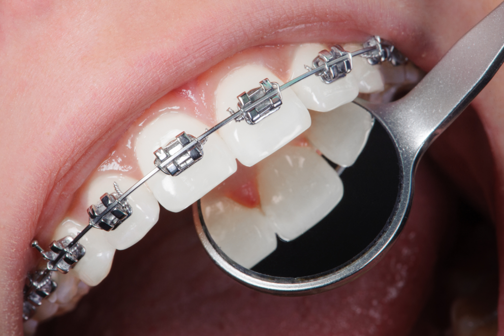 Orthodontic care Orthodontics Orthodontist Orthodontic treatment Braces Clear aligners Invisalign Brenham, Texas Smile Dental health Oral health Teeth alignment Straight teeth Misaligned teeth Crooked teeth Overbite Underbite Crossbite Dental provider Orthodontic issues