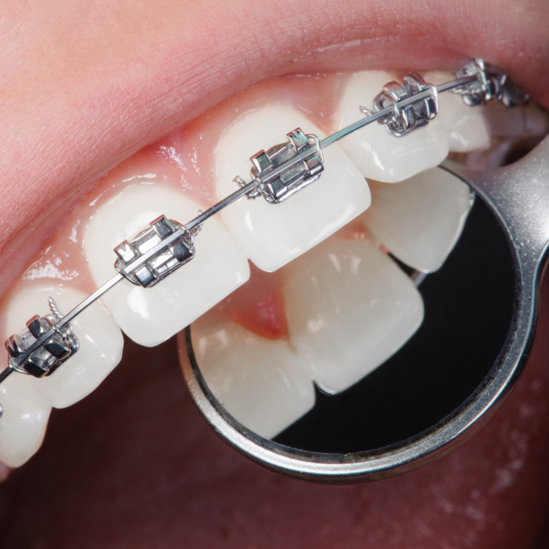 Orthodontic care Orthodontics Orthodontist Orthodontic treatment Braces Clear aligners Invisalign Brenham, Texas Smile Dental health Oral health Teeth alignment Straight teeth Misaligned teeth Crooked teeth Overbite Underbite Crossbite Dental provider Orthodontic issues