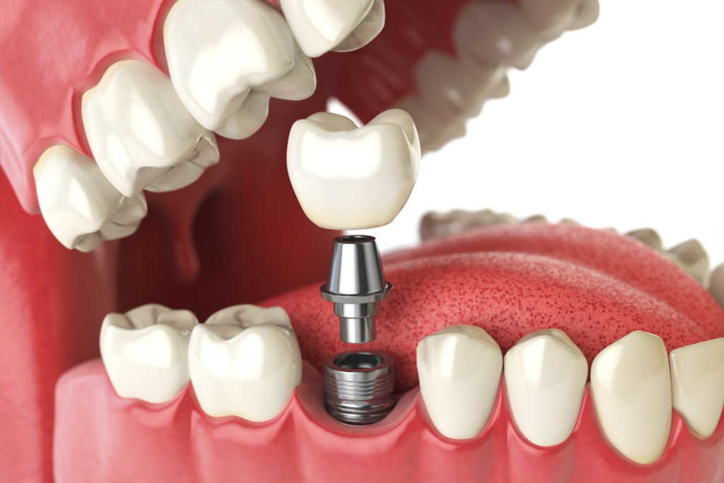 dental implant dental implants implants from dentists dentist implant