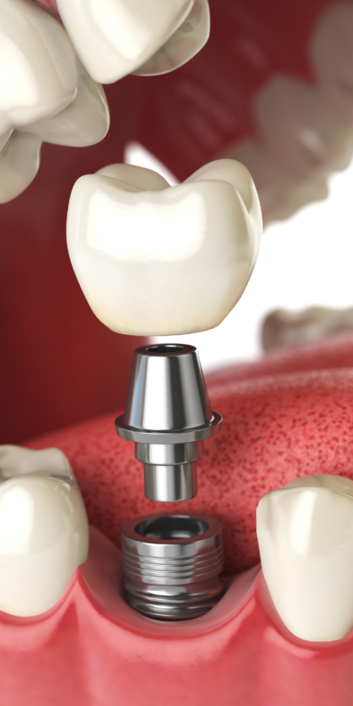 dental implant dental implants implants from dentists dentist implant