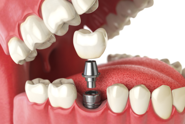 dental implant dental implants implants from dentists dentist implant