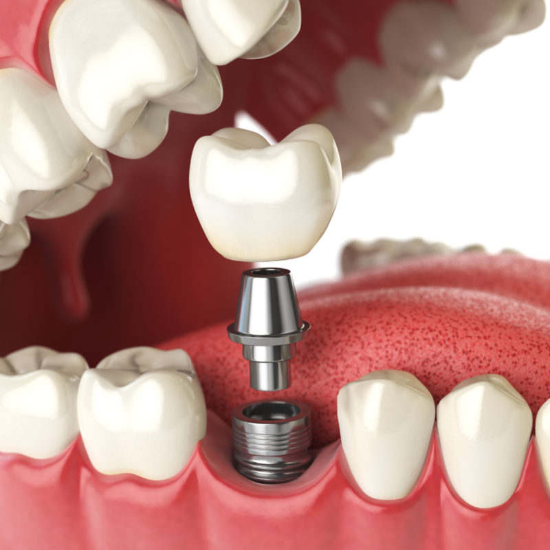 dental implant dental implants implants from dentists dentist implant